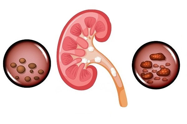 calcium renal calculi prevention