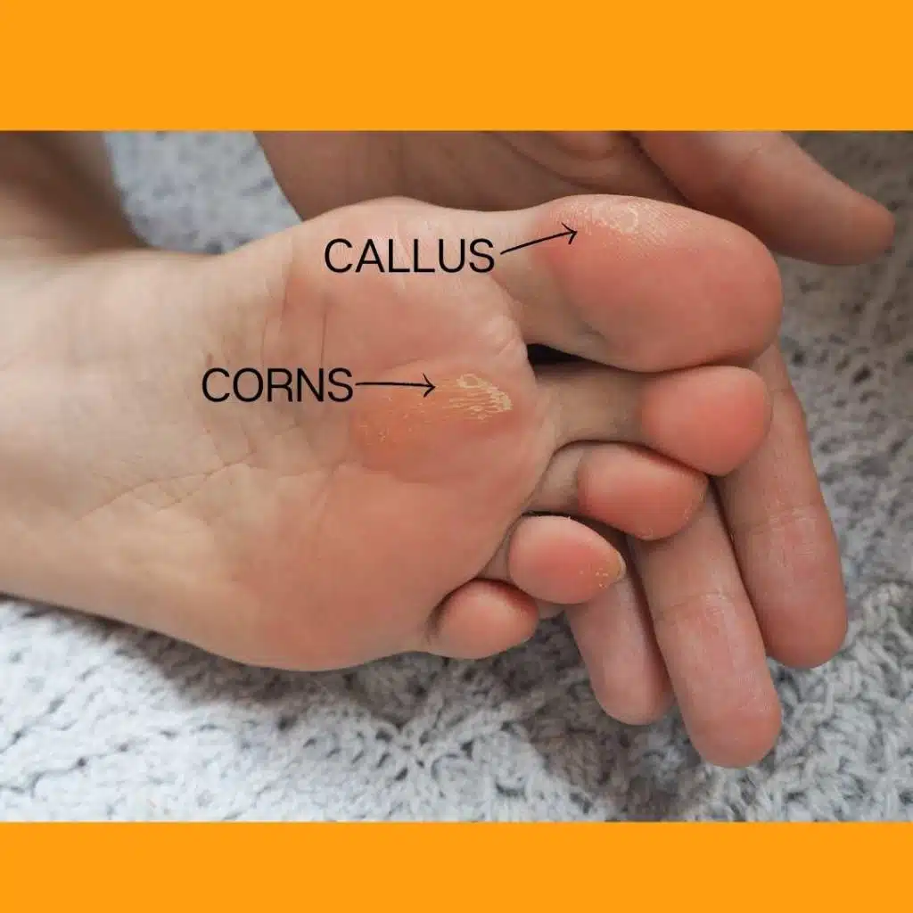 calluses and corns