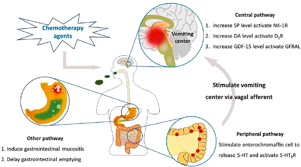 cancer chemotherapy-induced nausea and vomiting