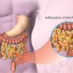 candida peritonitis