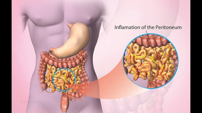 candida peritonitis