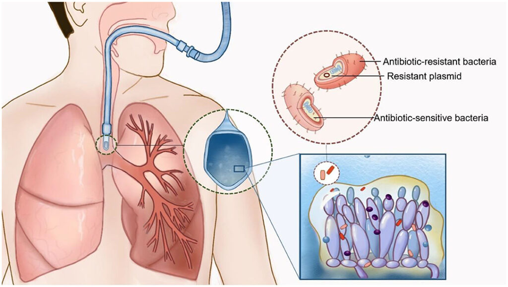 candida pleural space infection