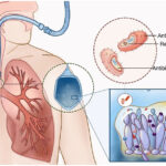 candida pleural space infection