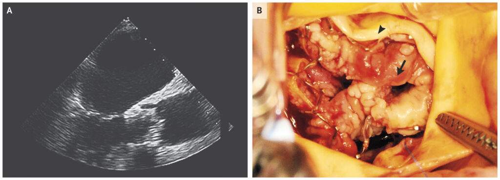 candidal endocarditis