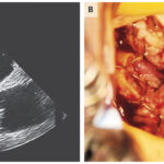 candidal endocarditis