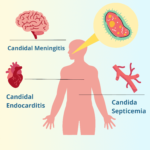 candidal septicemia