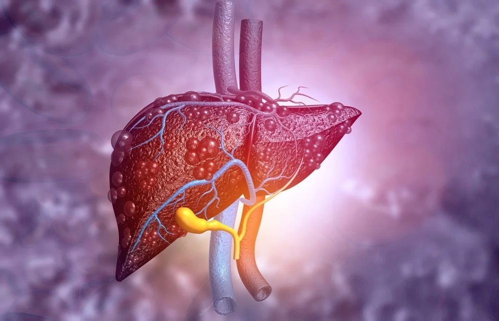 carbamoyl phosphate synthetase deficiency