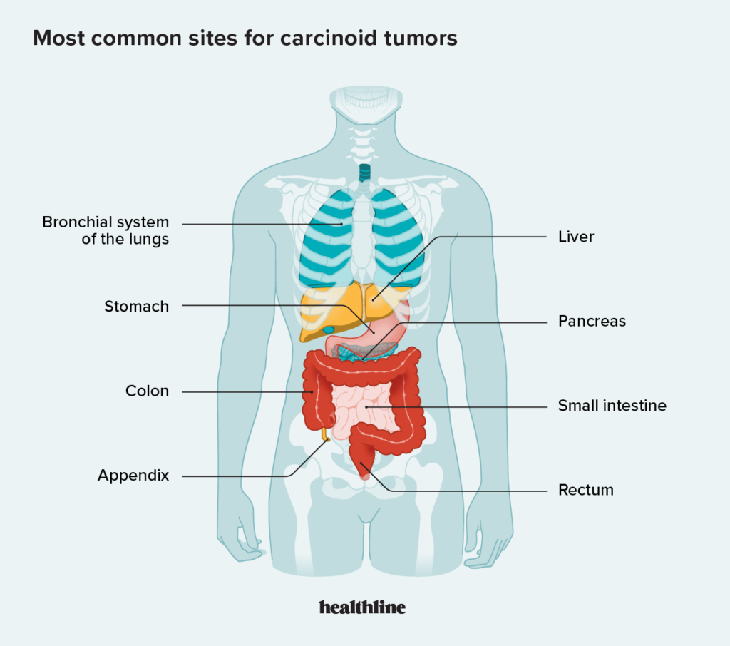 carcinoid syndrome