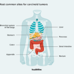 carcinoid syndrome