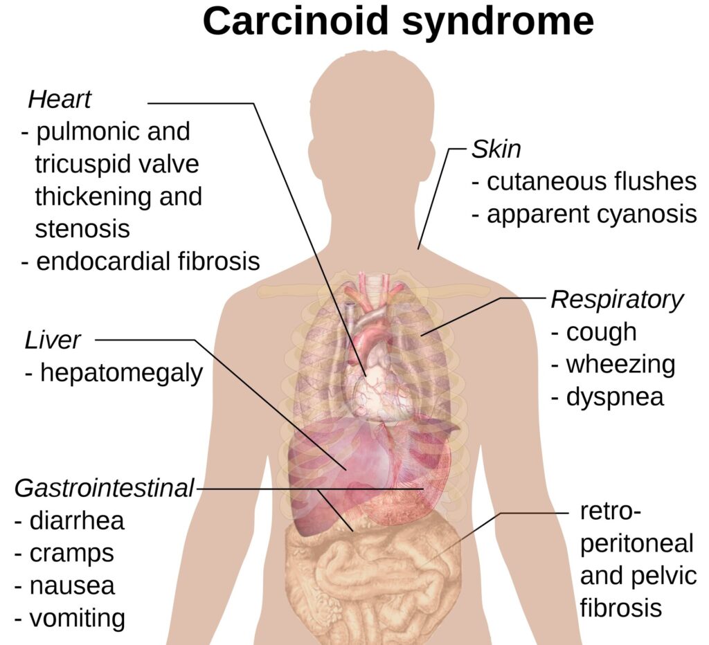 carcinoid syndrome diarrhea