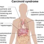 carcinoid syndrome diarrhea