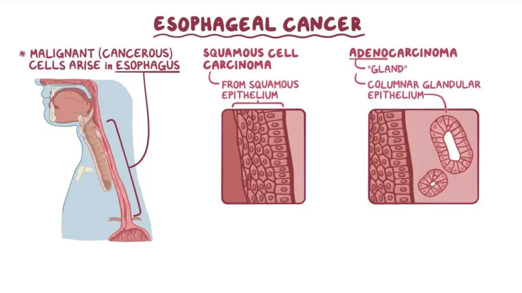 carcinoma in situ of the esophagus