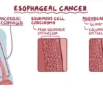 carcinoma in situ of the esophagus