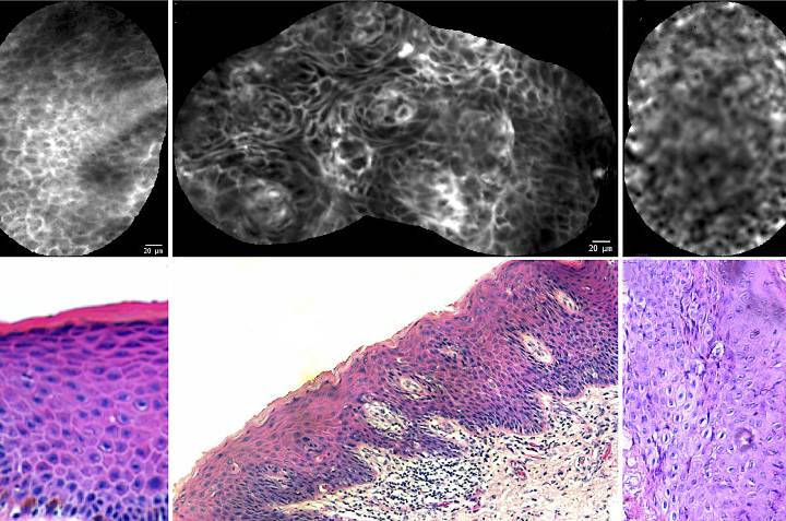 carcinoma in situ of the glans penis