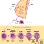 carcinoma of breast