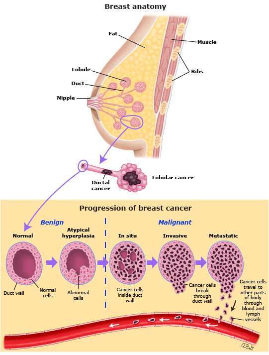 carcinoma of breast