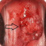 carcinoma of cervix