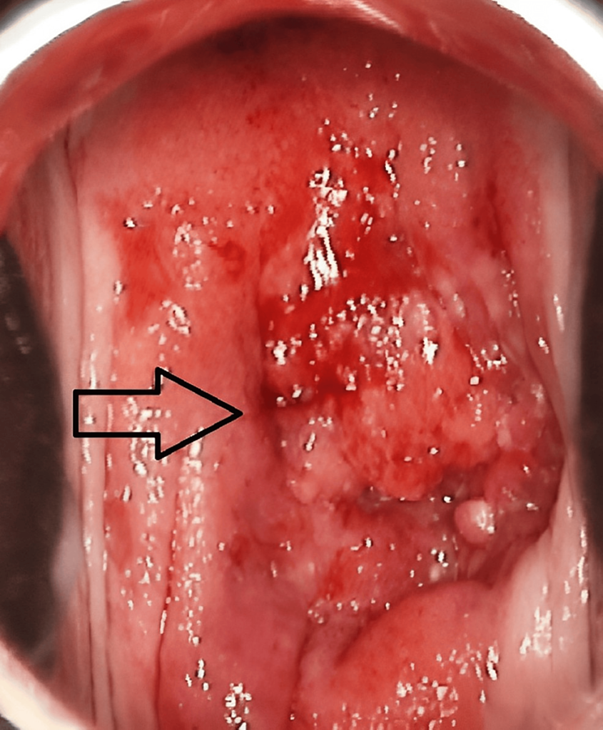 carcinoma of cervix