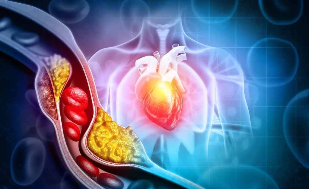 cardiovascular disease associated with type 2 diabetes mellitus