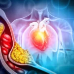 cardiovascular disease associated with type 2 diabetes mellitus