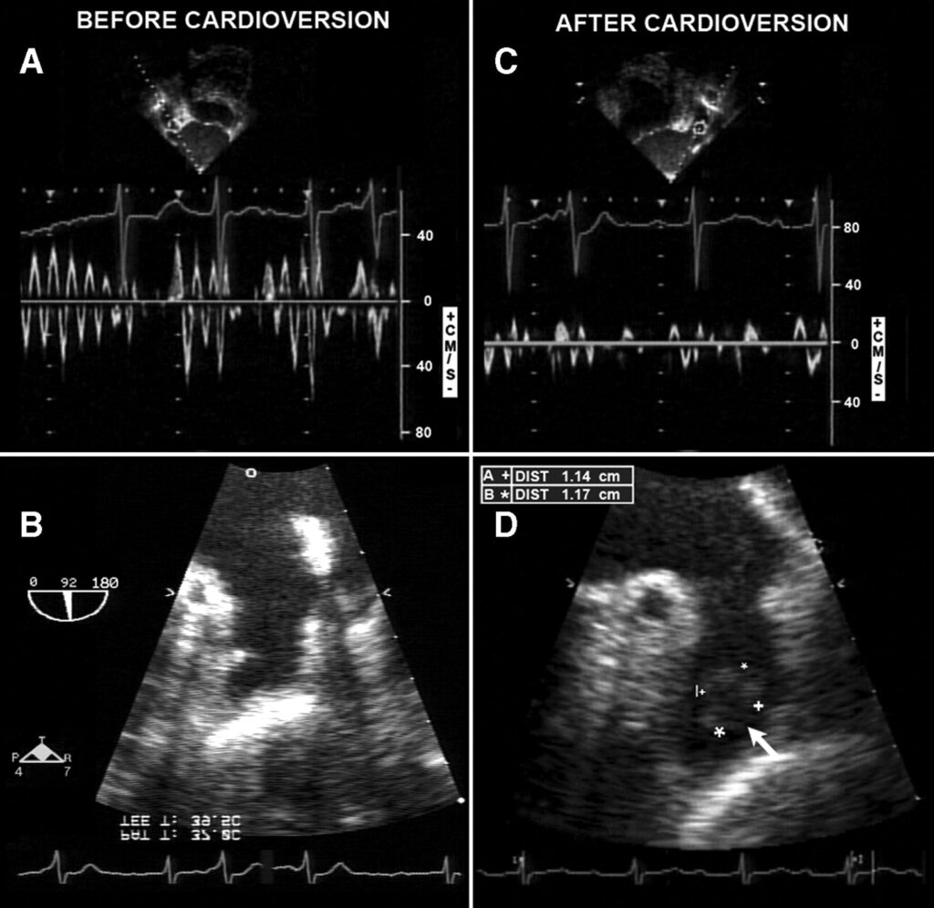 cardioversion of atrial fibrillation