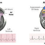 cardioversion of atrial flutter