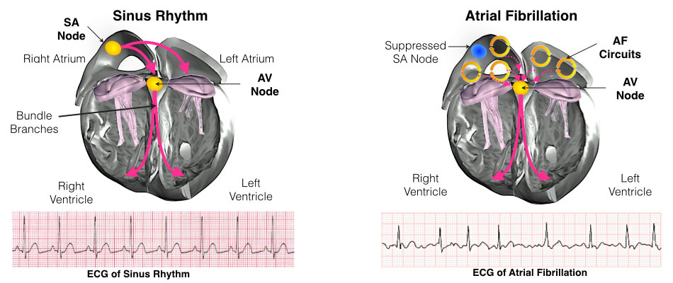 cardioversion of atrial flutter