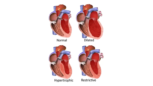 carnitine deficiency