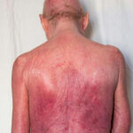 cd25-positive cutaneous t-cell lymphoma