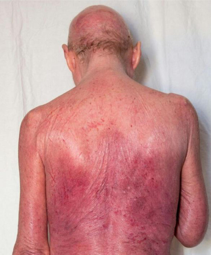 cd25-positive cutaneous t-cell lymphoma