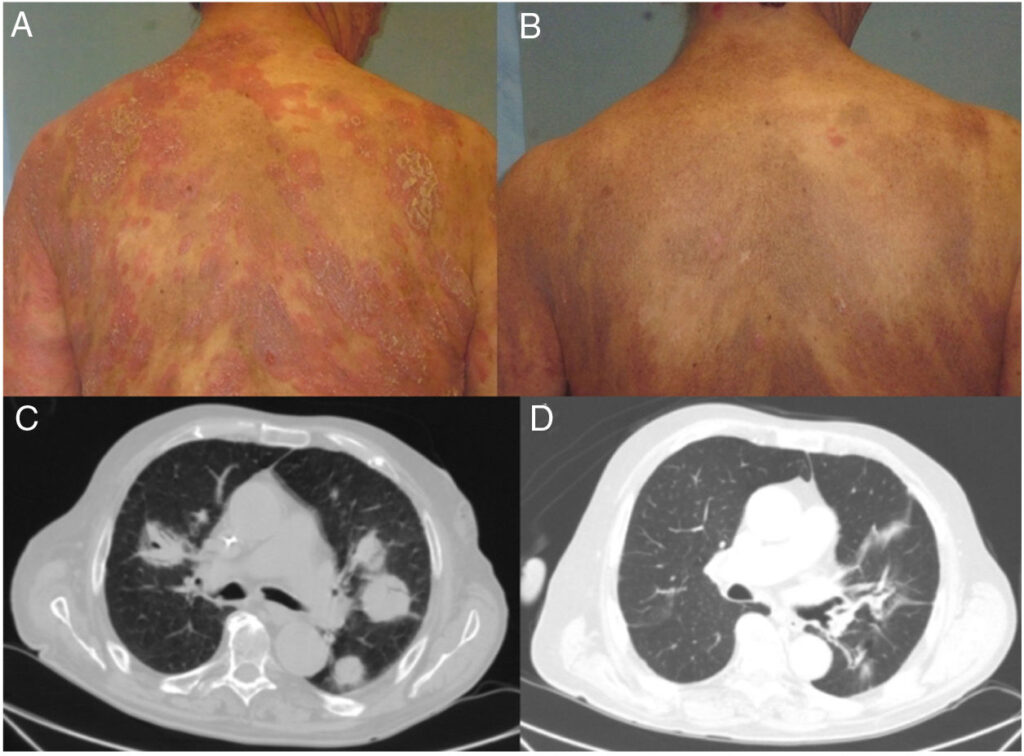 cd30-positive mycosis fungoides