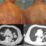 cd30-positive mycosis fungoides