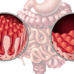 celiac disease