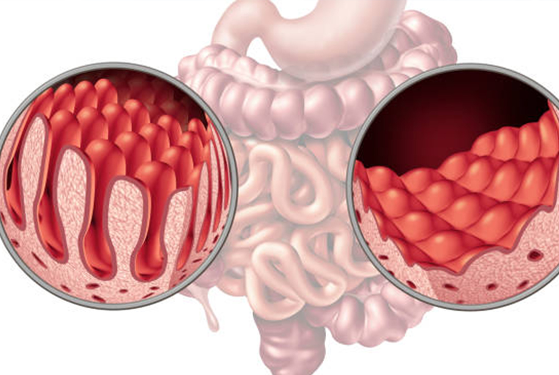 celiac disease