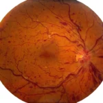 central retinal vein occlusion with macular edema