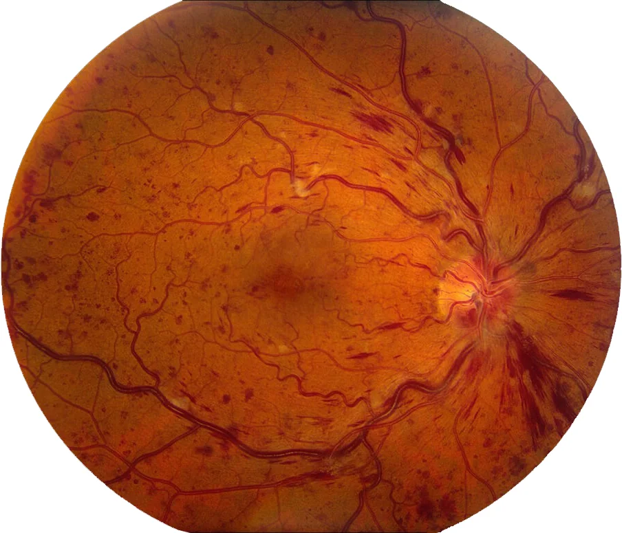 central retinal vein occlusion with macular edema