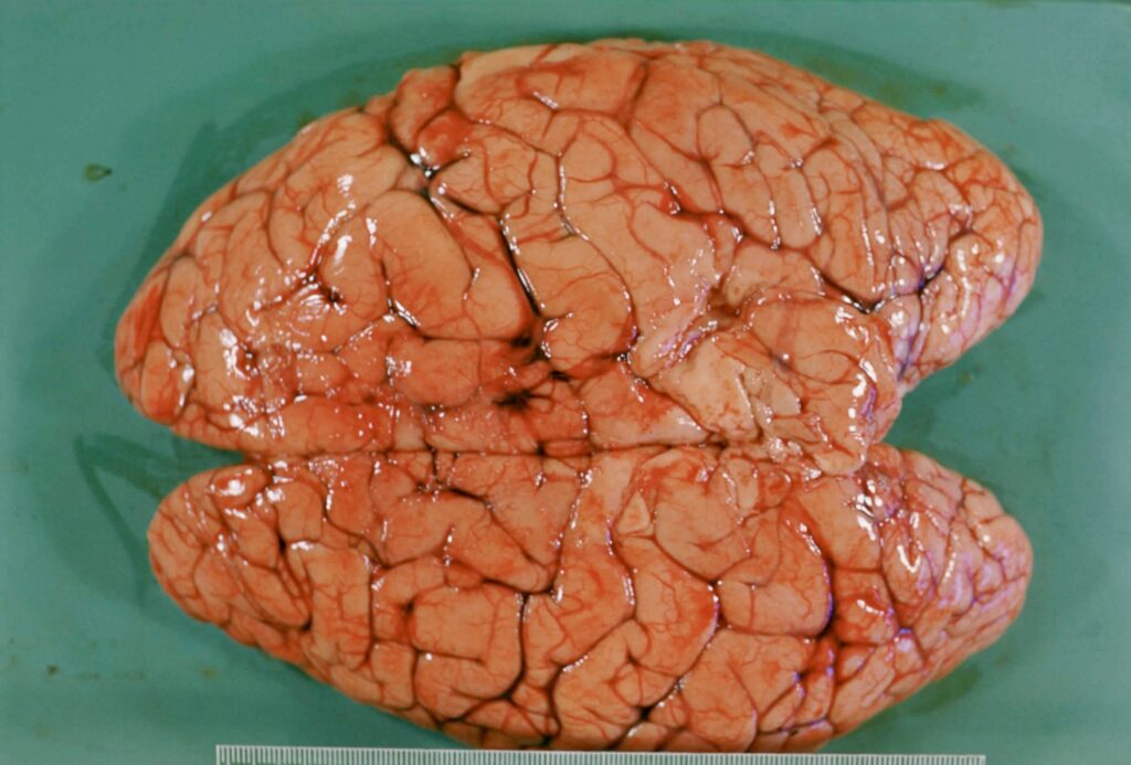 cerebral oedema