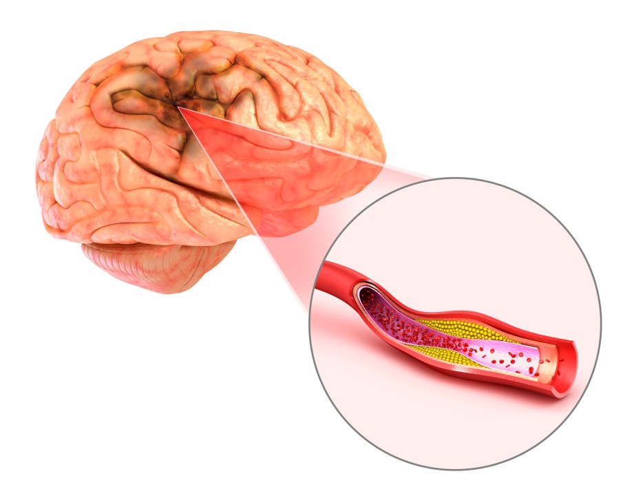 cerebral ischemia