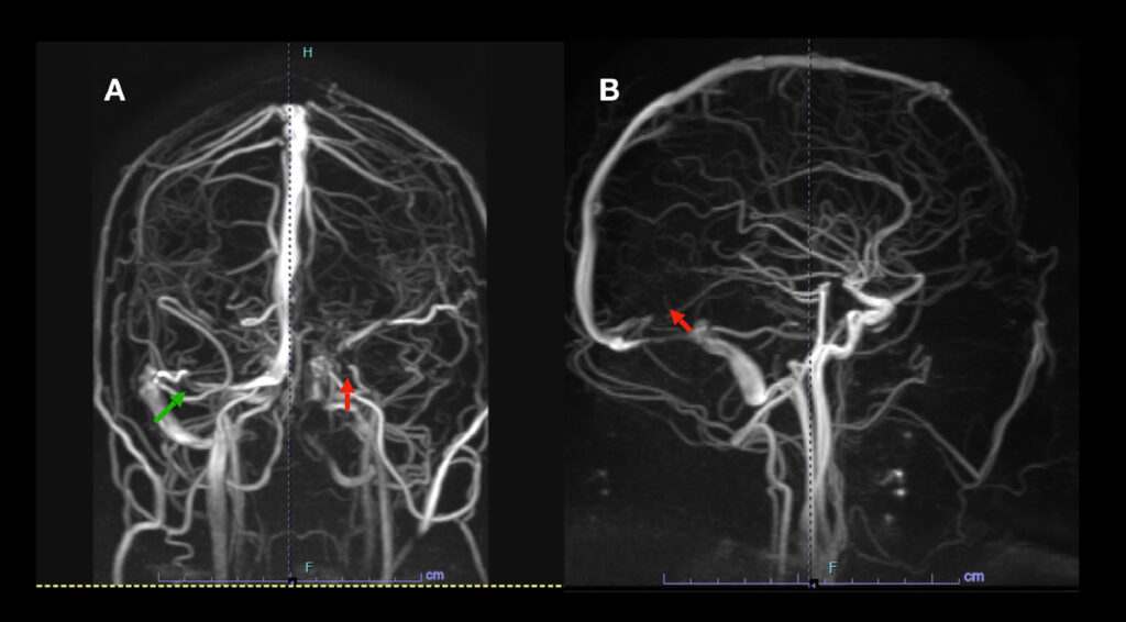 cerebral thromboembolism prevention