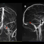 cerebral thromboembolism prevention