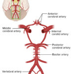 cerebrovascular occlusion