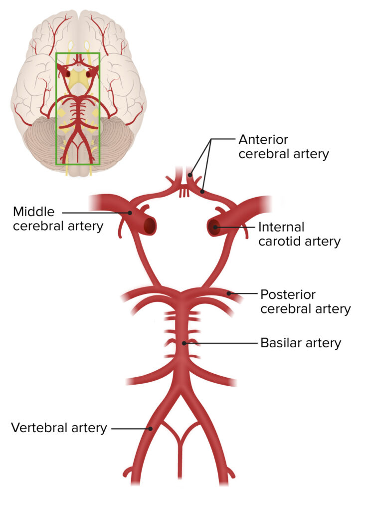 cerebrovascular occlusion