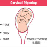 cervical ripening procedure