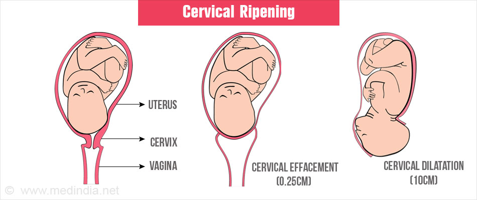 cervical ripening procedure