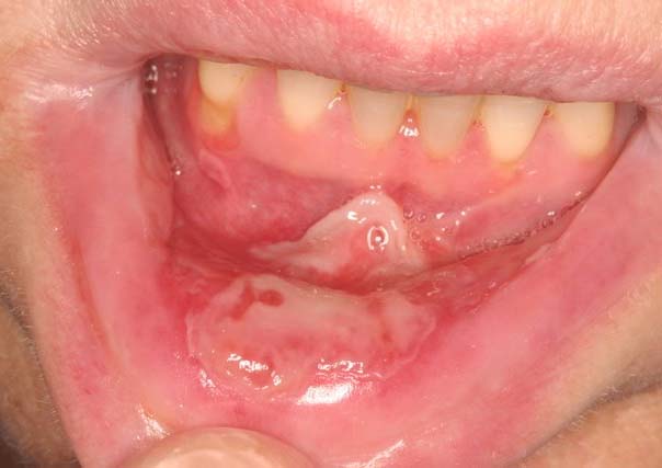 chemotherapy-induced mucositis