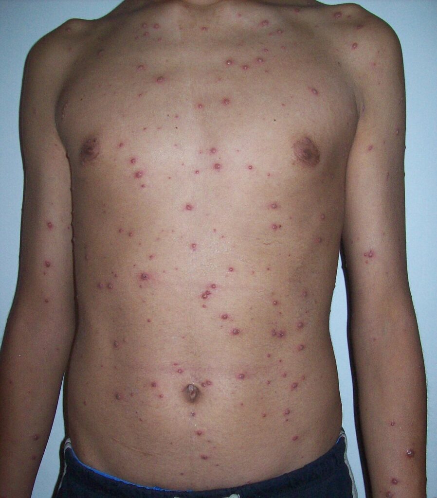 chickenpox