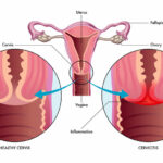 chlamydia cervicitis