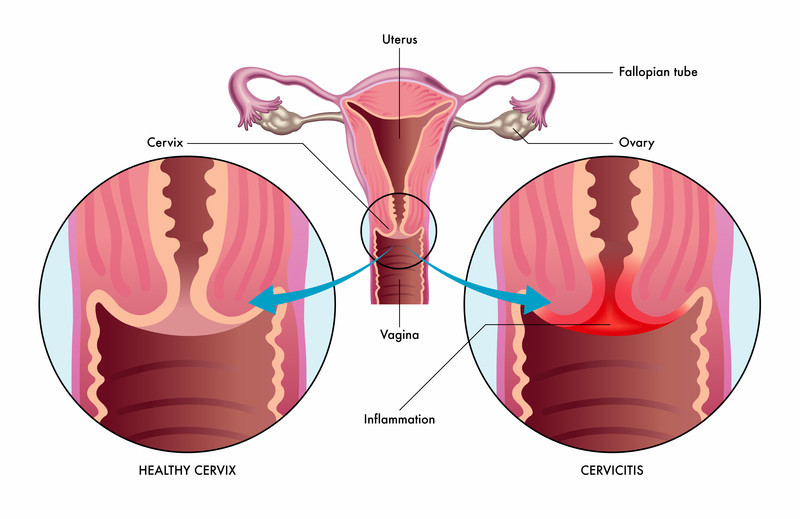 chlamydia cervicitis