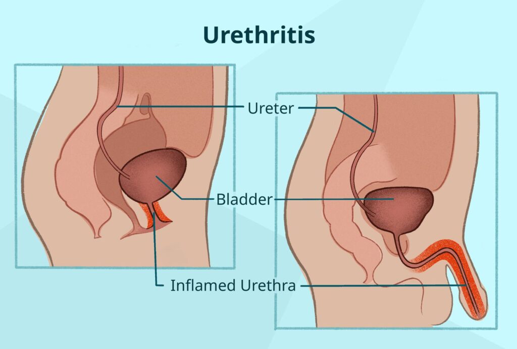 chlamydia trachomatis urethritis