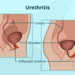 chlamydia trachomatis urethritis